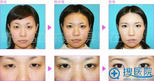 保志名胜埋线双眼皮案例八 保志名胜埋线双眼皮案例八