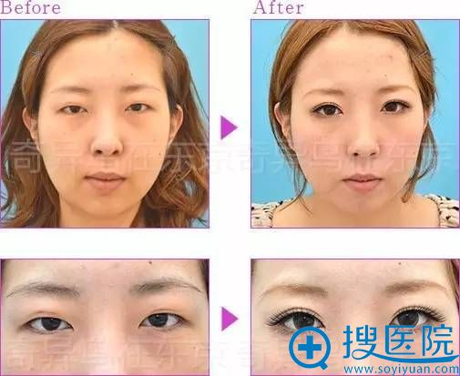 保志名胜埋线双眼皮案例五 保志名胜埋线双眼皮案例五