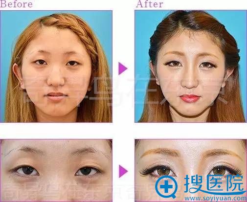 保志名胜埋线双眼皮案例四 保志名胜埋线双眼皮案例四
