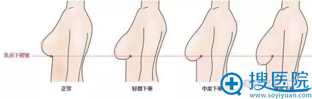 乳房下垂过程演变示意图 乳房下垂过程演变示意图