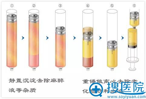在日本,很多整形医院脂肪的处理方法使用CRF注入隆胸。 在日本,很多整形医院脂肪的处理方法使用CRF注入隆胸。
