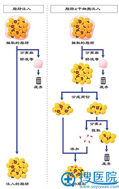 CRF注入法与此前脂肪注入示意图对比 CRF注入法与此前脂肪注入示意图对比
