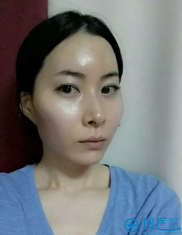 新帝瑞娜颧骨内推缩小术真人案例 实现完美面部轮廓