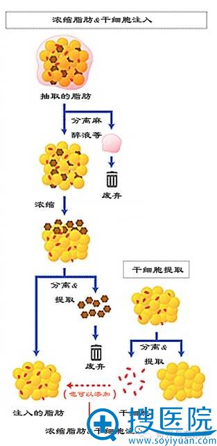 日本自体脂肪丰胸CRF注入隆胸演示图片 日本自体脂肪丰胸CRF注入隆胸演示图片