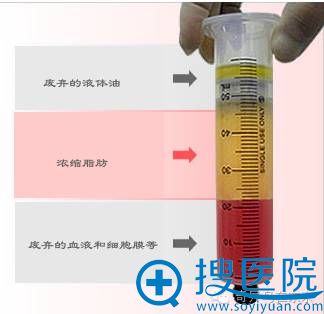 CRF脂肪注入完成后示意图展示 CRF脂肪注入完成后示意图展示