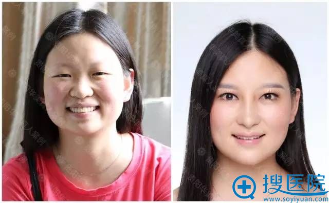 贵阳华美双11特惠双眼皮特价999元 玻尿酸+免费送