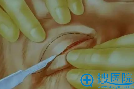专访福州比华利整形院长林潮教授 割双眼皮到底会不会痛
