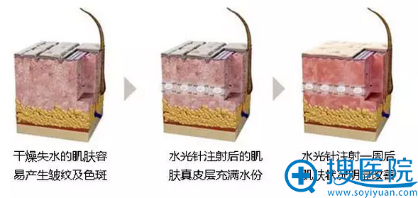 肌肤注射后的状态 肌肤注射后的状态
