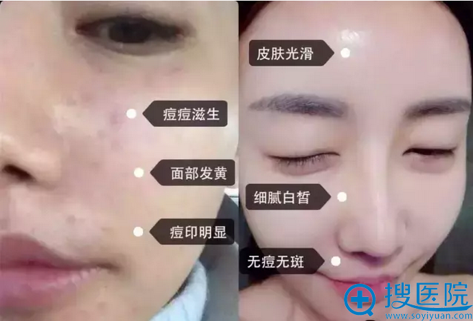 润百颜注射真人案例 润百颜注射真人案例