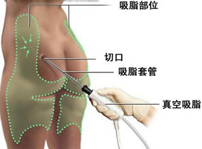 天津全身吸脂整形价格表 全身吸脂助你塑造完美身材