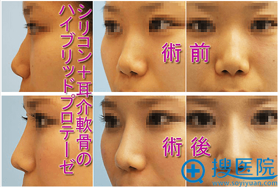 木村知史鼻子案例1 木村知史鼻子案例1