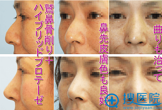 木村知史鼻尖延长案例 木村知史鼻尖延长案例