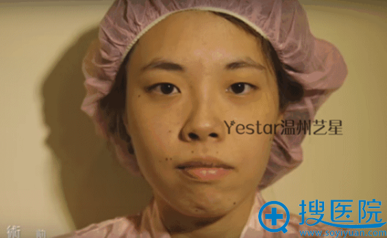纳尼?隆鼻后,脸会瘦下来?来听听温州艺星怎么说