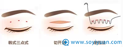 林潮博士解说:全切开割双眼皮法疤痕真的能藏得住吗