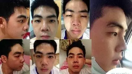 术后恢复中 术后恢复中