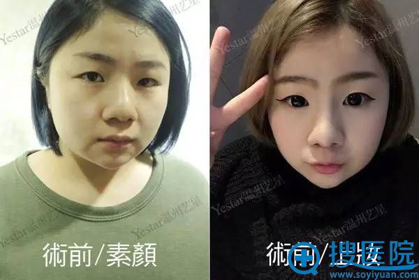 温州艺星真人案例为你解析割双眼皮那些神误解 真相直戳心窝