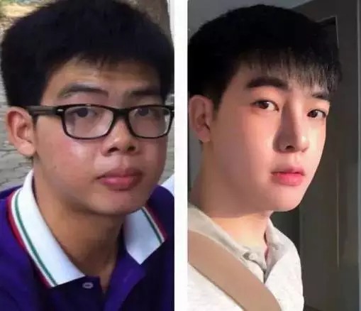 手术前后对比照片 手术前后对比照片