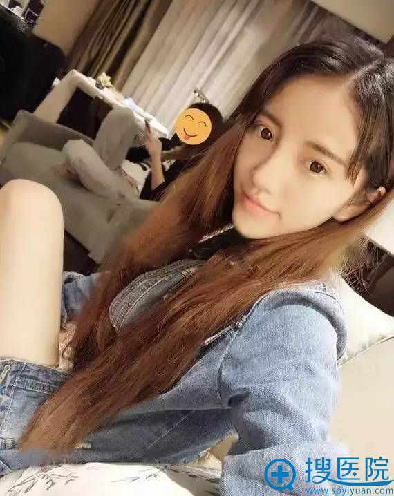 双眼皮和鼻综合一起做的哦 双眼皮和鼻综合一起做的哦