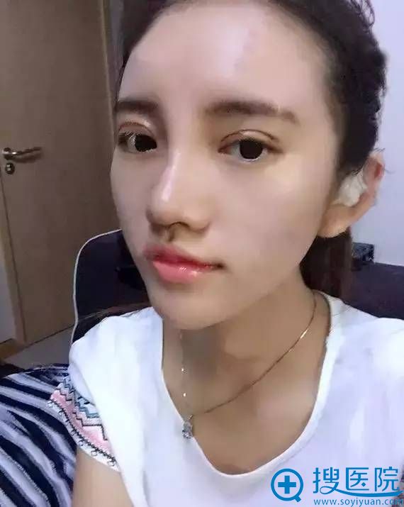 术后一周的我 术后一周的我