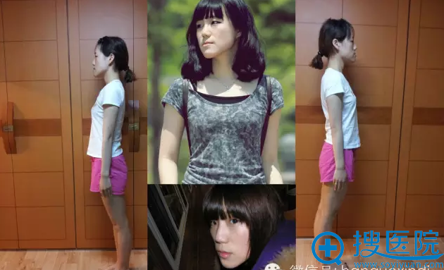 新帝瑞娜4D均衡双鄂手术真人案例 实现美和事业的双丰收