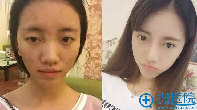 双眼皮+隆鼻术前术后对比图 双眼皮+隆鼻术前术后对比图