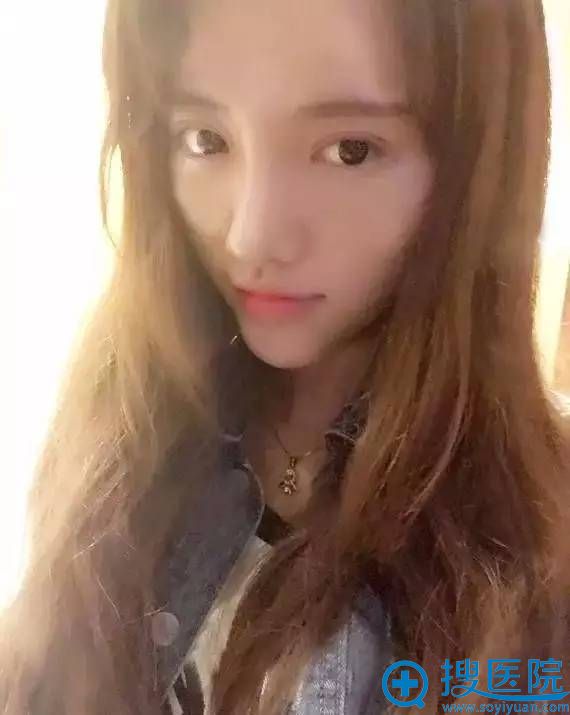 术后照片,双眼皮很自然吧 术后照片,双眼皮很自然吧