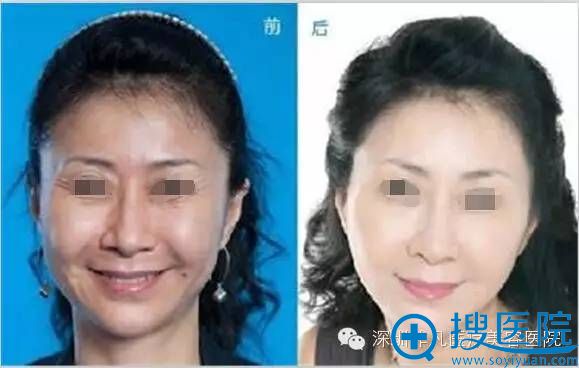 深圳非凡除鱼尾纹案例 深圳非凡除鱼尾纹案例
