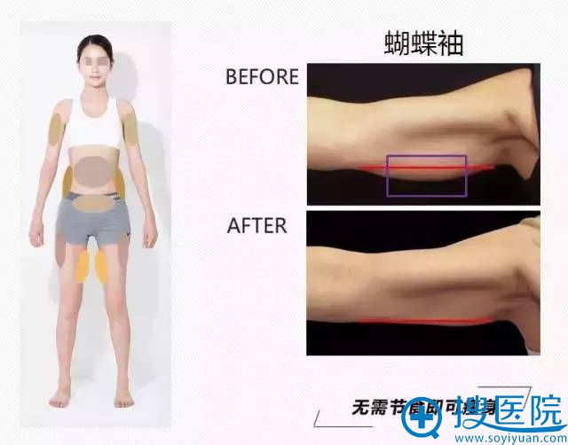 蝴蝶袖消除案例 蝴蝶袖消除案例