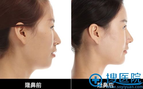 整形案例 整形案例