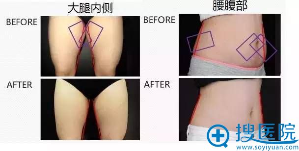 大腿、腰腹部吸脂案例 大腿、腰腹部吸脂案例