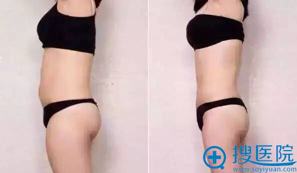 全身吸脂案例 全身吸脂案例