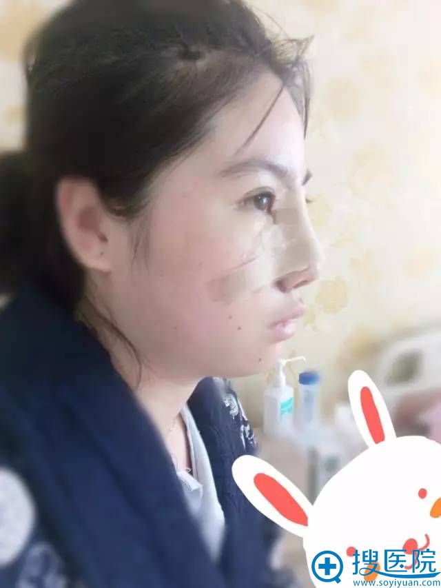 鼻综合术后效果展示 鼻综合术后效果展示