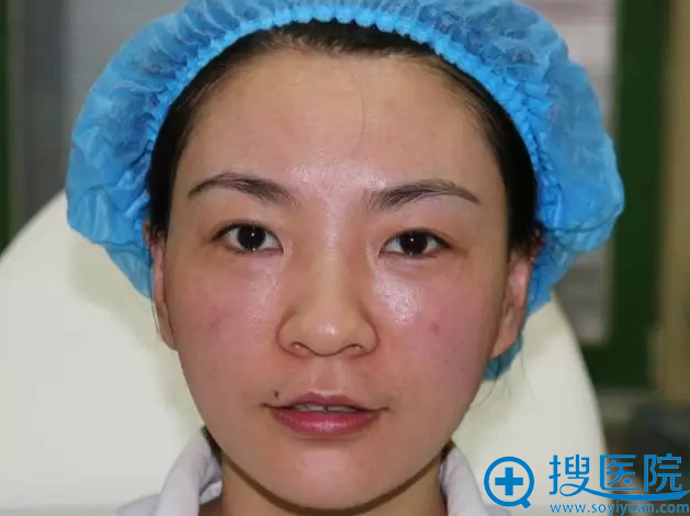 术后效果 术后效果