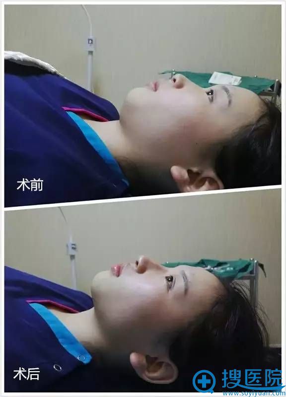 术前术后对比照 术前术后对比照