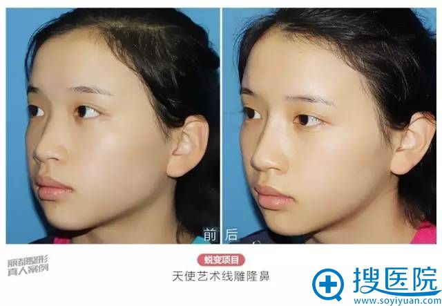 隆鼻后侧面对比照 隆鼻后侧面对比照