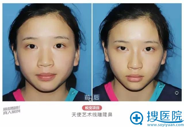 隆鼻后正面对比照 隆鼻后正面对比照
