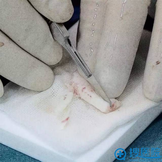 耳软骨雕刻 耳软骨雕刻