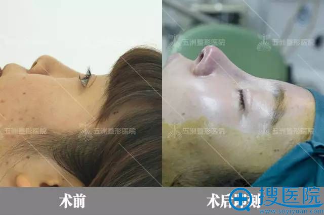 术后即刻效果展示 术后即刻效果展示