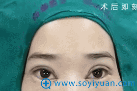 术后即刻眼部效果 术后即刻眼部效果