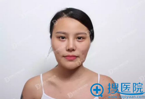 韩国女神轮廓手术真人案例 吊炸天的换头记录