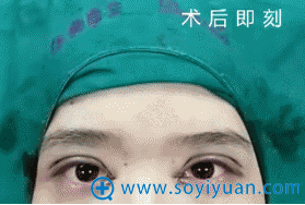 假性眼睑下垂术后效果 假性眼睑下垂术后效果