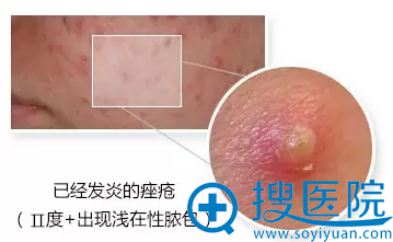 炎性丘疹 炎性丘疹