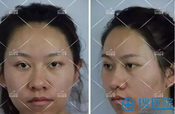 第五次治疗后 第五次治疗后