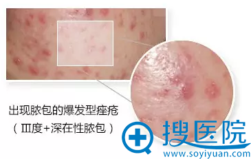 脓包 脓包