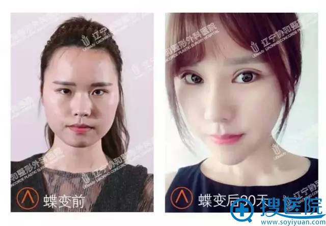 术前术后对比照 术前术后对比照