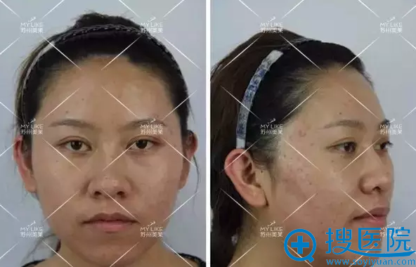 第三次治疗后效果 第三次治疗后效果