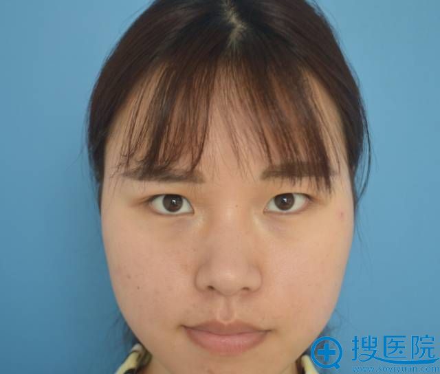 术前照片 术前照片
