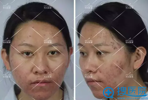 第二次治疗后效果 第二次治疗后效果