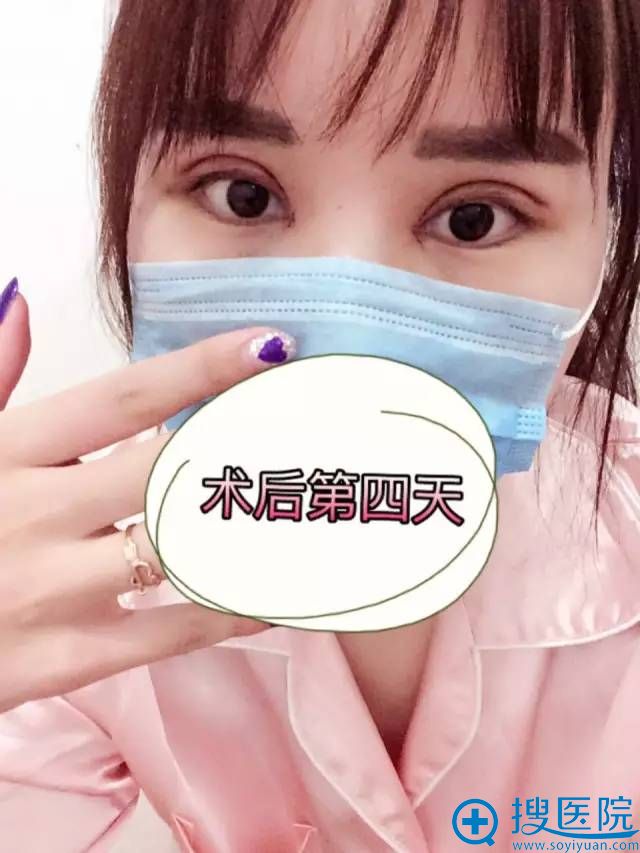 术后第四天效果 术后第四天效果