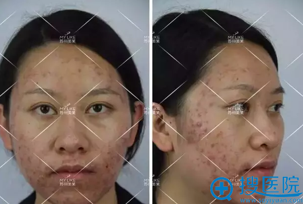次治疗后效果 次治疗后效果